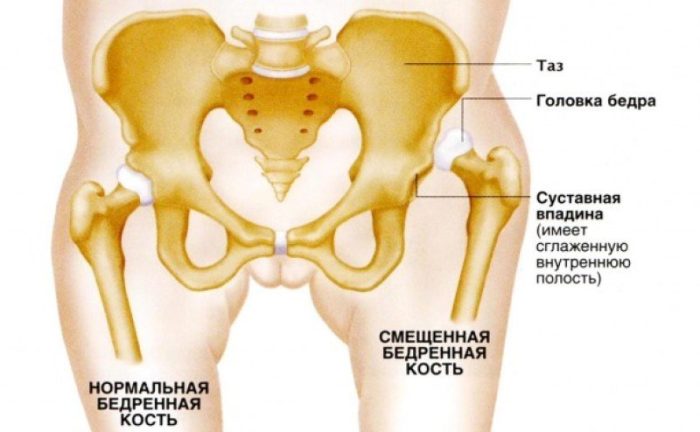 Что такое тазобедренная дисплазия у детей